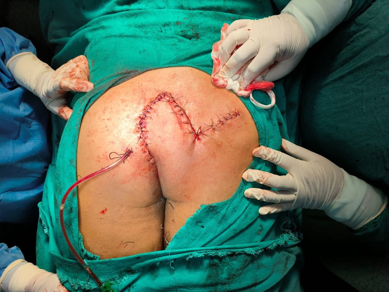 Stump cholecystectomy